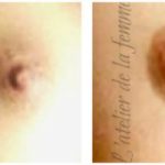 Aréole mammaire tatouage réparateur